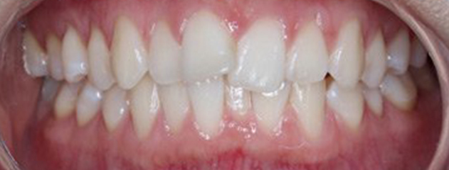 Before Invisalign® treatment