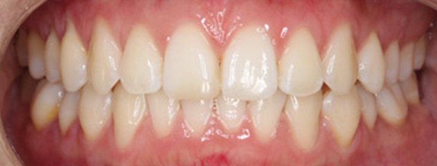 After Invisalign® treatment at Auckland City Orthodontics
